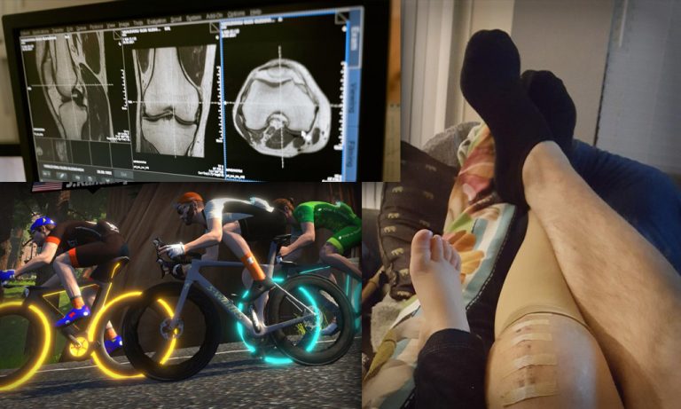 An Active Approach to Cycling Injuries: Total Knee Replacement